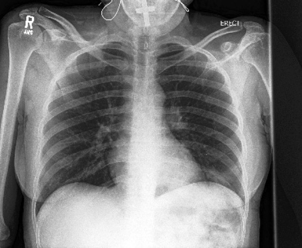 AI System More Accurately Identifies Collapsed Lungs Using Chest X-Rays